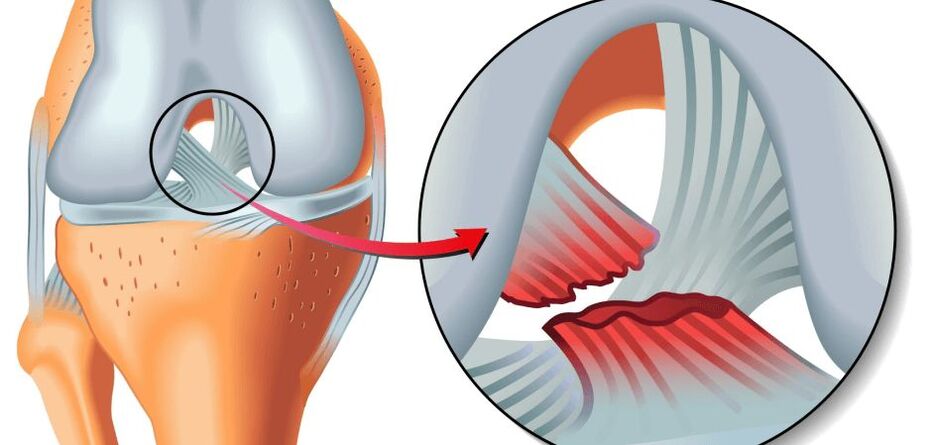 articulación de la rodilla lesionada