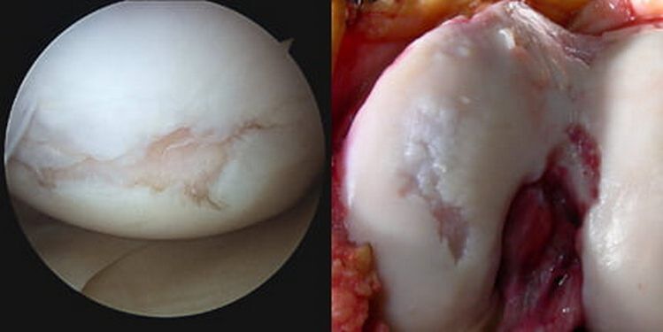 el daño a la articulación de la rodilla es visible durante la operación