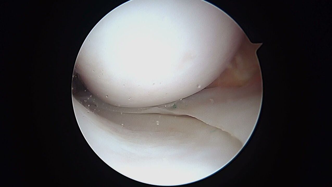vista de la articulación de la rodilla a través del artroscopio