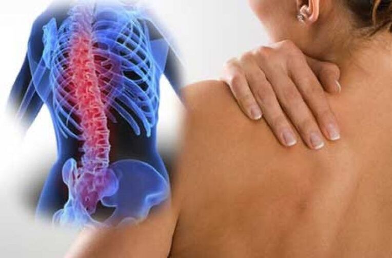 Con la osteocondrosis, el dolor puede irradiarse a partes distantes del cuerpo. 