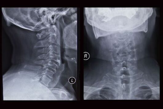 Imagen de rayos X de la columna cervical (el paciente tiene osteocondrosis)