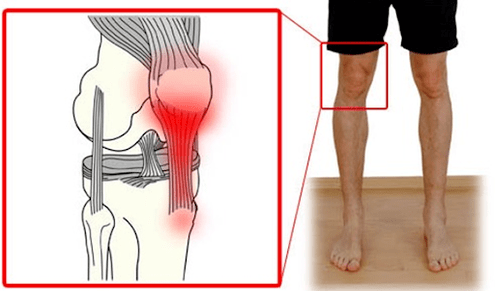 La tendinitis es una inflamación del tejido del tendón que causa dolor en la articulación de la rodilla. 