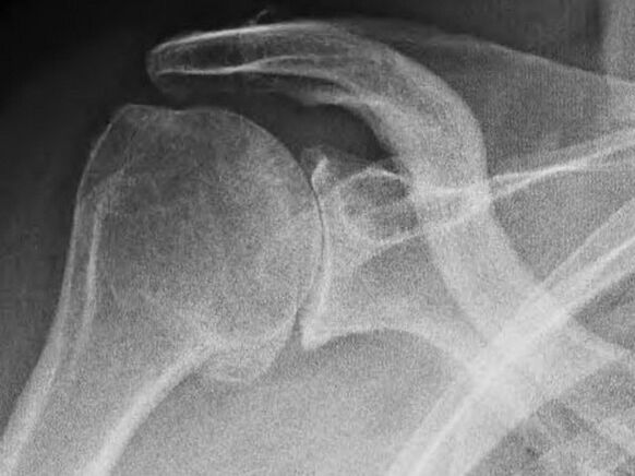 Radiografía de una articulación del hombro afectada por artrosis. 