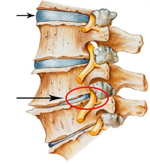 osteocondrosis cervical