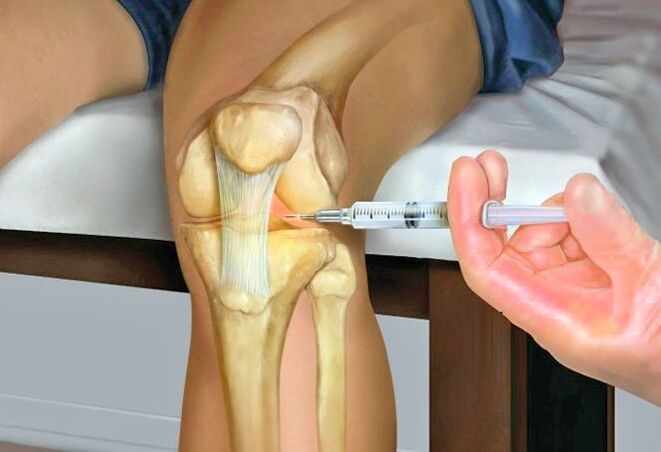 Tratamiento de la artrosis de la articulación de la rodilla