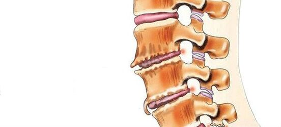 Espondilosis destrucción de articulaciones intervertebrales