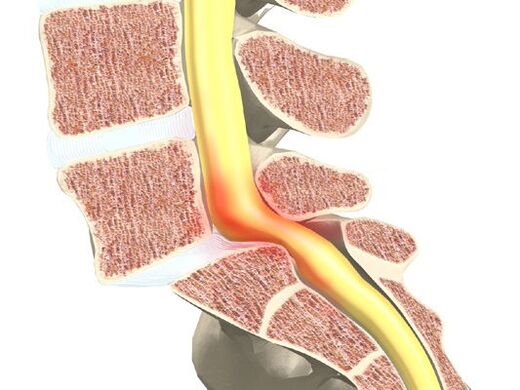 Segmento de moto de sangre para la osteocondrosis