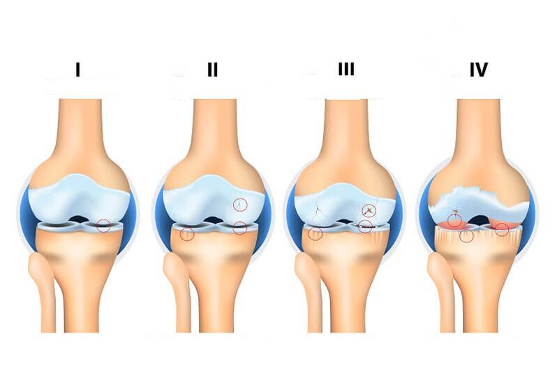 etapas de la artrosis articular