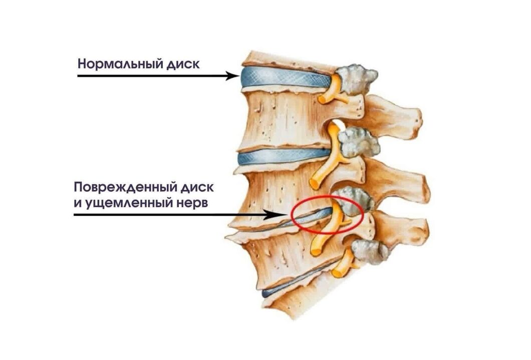Síntomas de la osteocondrosis cervical.