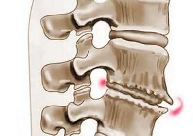 Daño a las vértebras en la osteocondrosis torácica.
