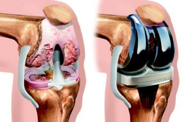 antes y después de la artrosis de la articulación de la rodilla por artrosis