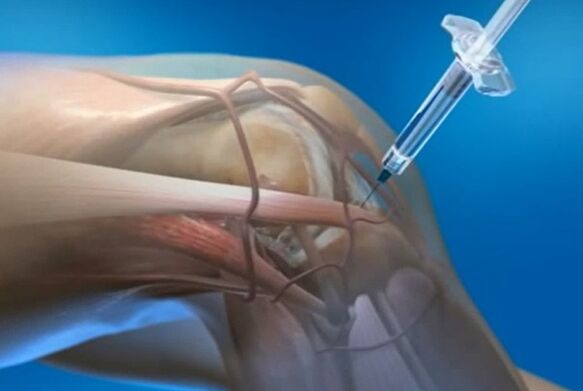 inyecciones intraarticulares para la artrosis de la articulación de la rodilla
